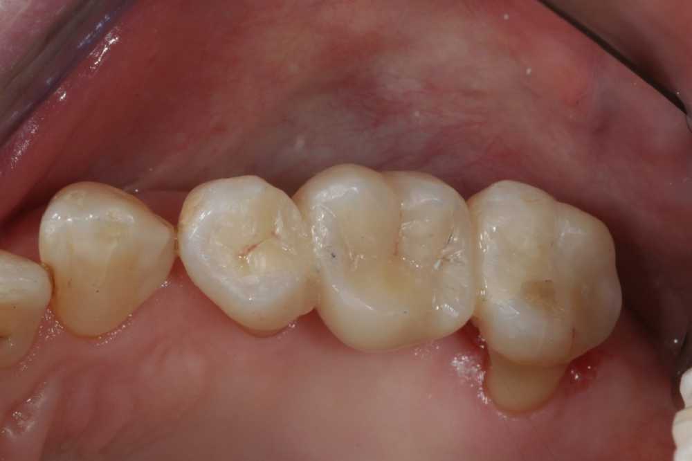 Afbeelding van Composiet Treatments/Etsbrug