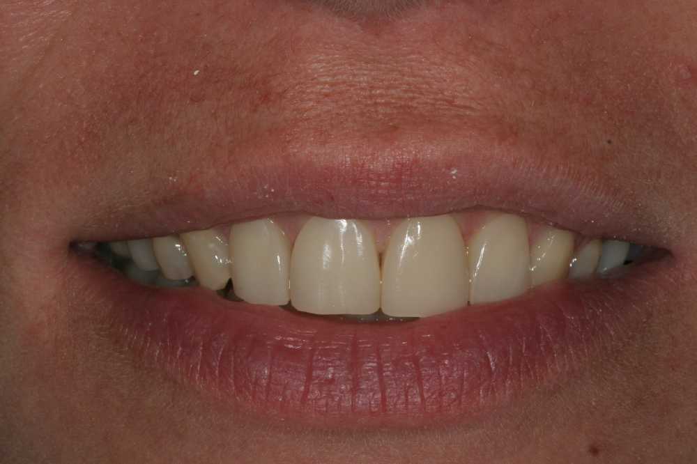 Afbeelding van Compo Facings